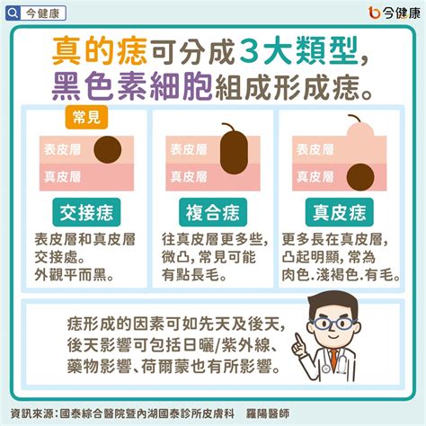 身體長痣的原因|是痣？皮膚癌？還是什麼？常見Q&A解惑！醫教揪出「。